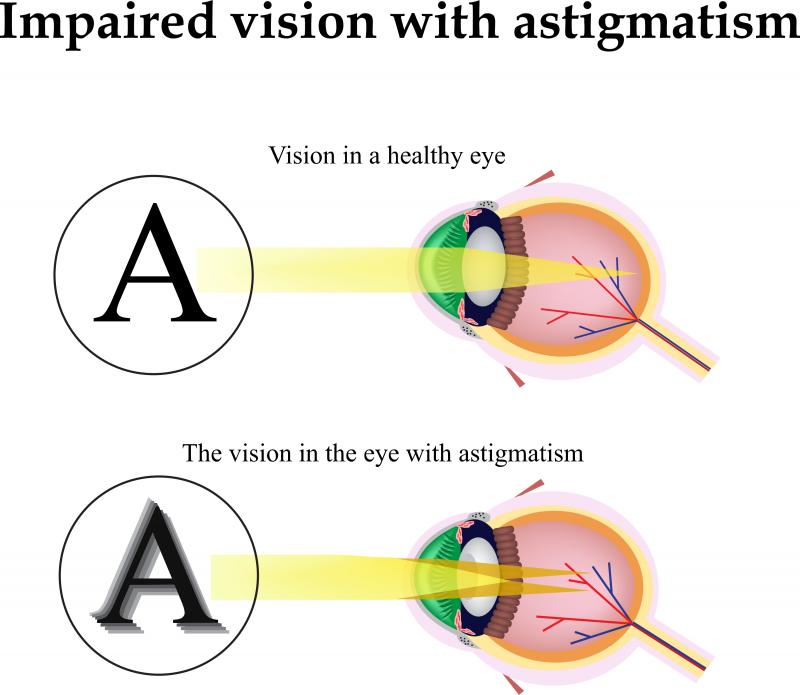 Can my astigmatism be corrected with cataract surgery?