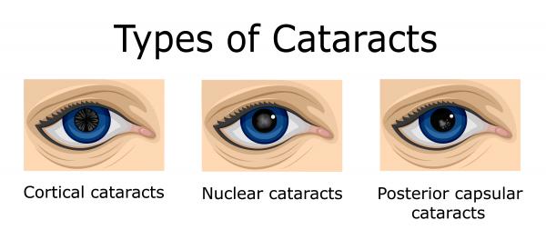 What kind of cataract do I have?